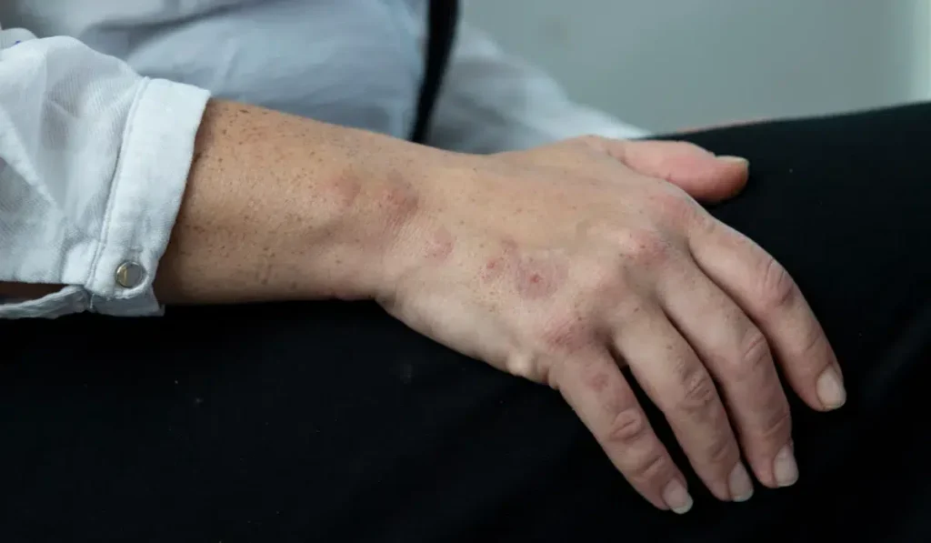 Bed Bug Bites