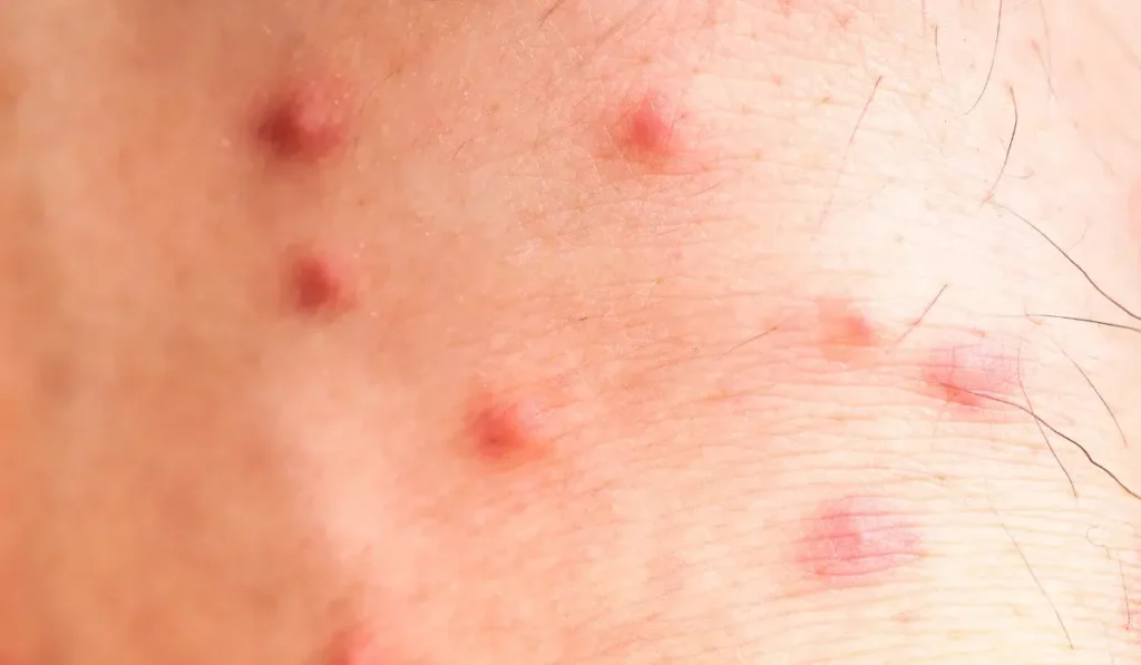 Flea Bites (2)