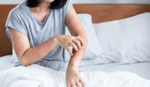 Bed bug bite